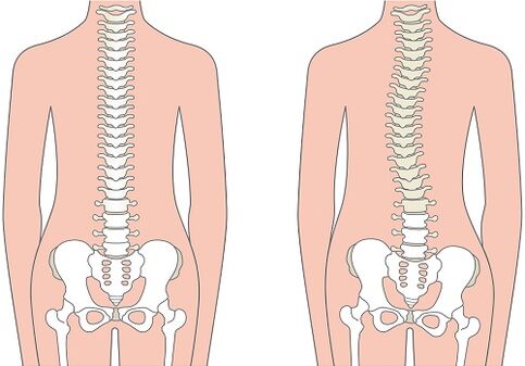 Low back pain due to spinal deformity such as scoliosis