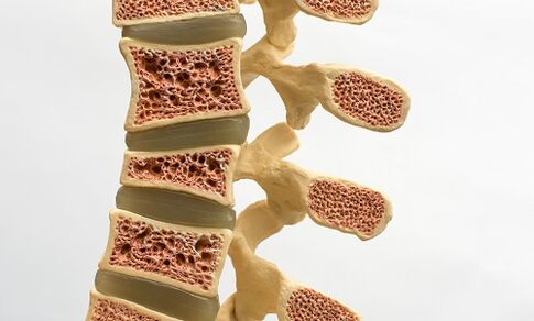 Osteoporosis is one of the causes of back pain