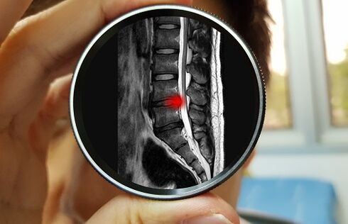 The consequence of ignoring back pain can be a herniated disc. 
