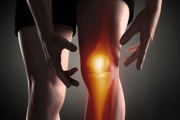 Arthritis of the knee joint