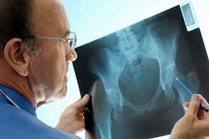 Arthrosis of the hip node in X -Ray