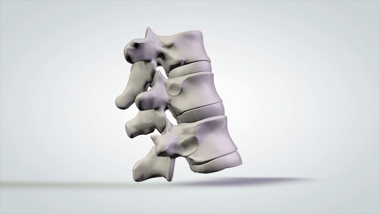 spinal cord injury due to cervical osteochondrosis