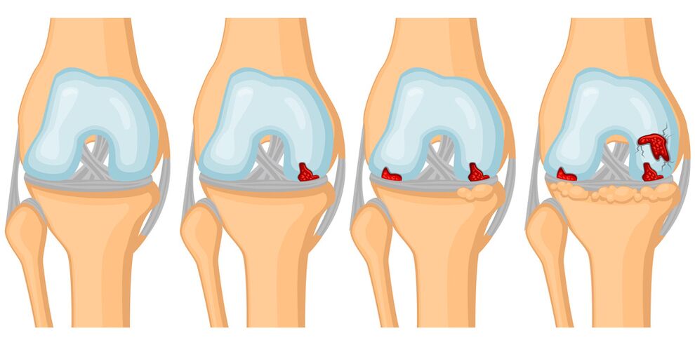 The rate of development of joint arthrosis
